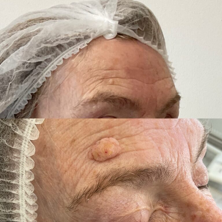 Diathermy B&A