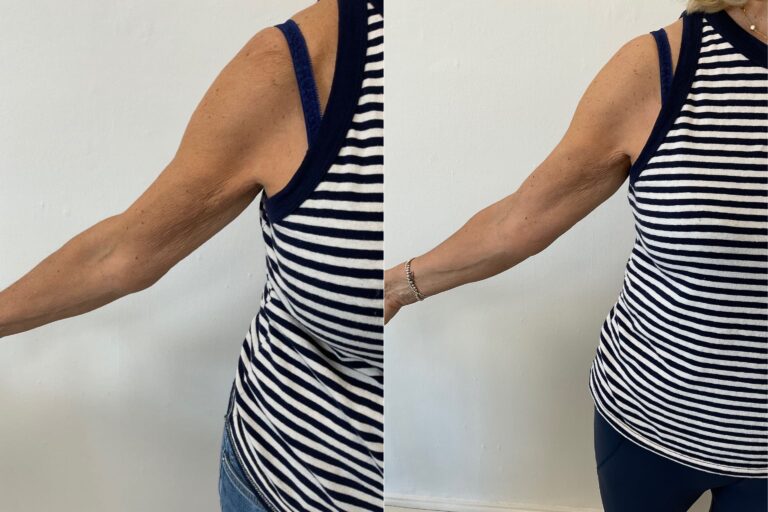 Sculptra Body B&A
